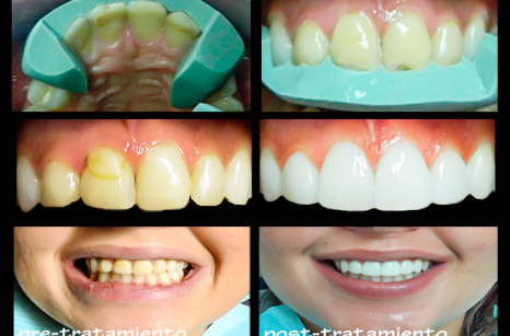 Casos&Procedimientos-Bef&Aft-04A